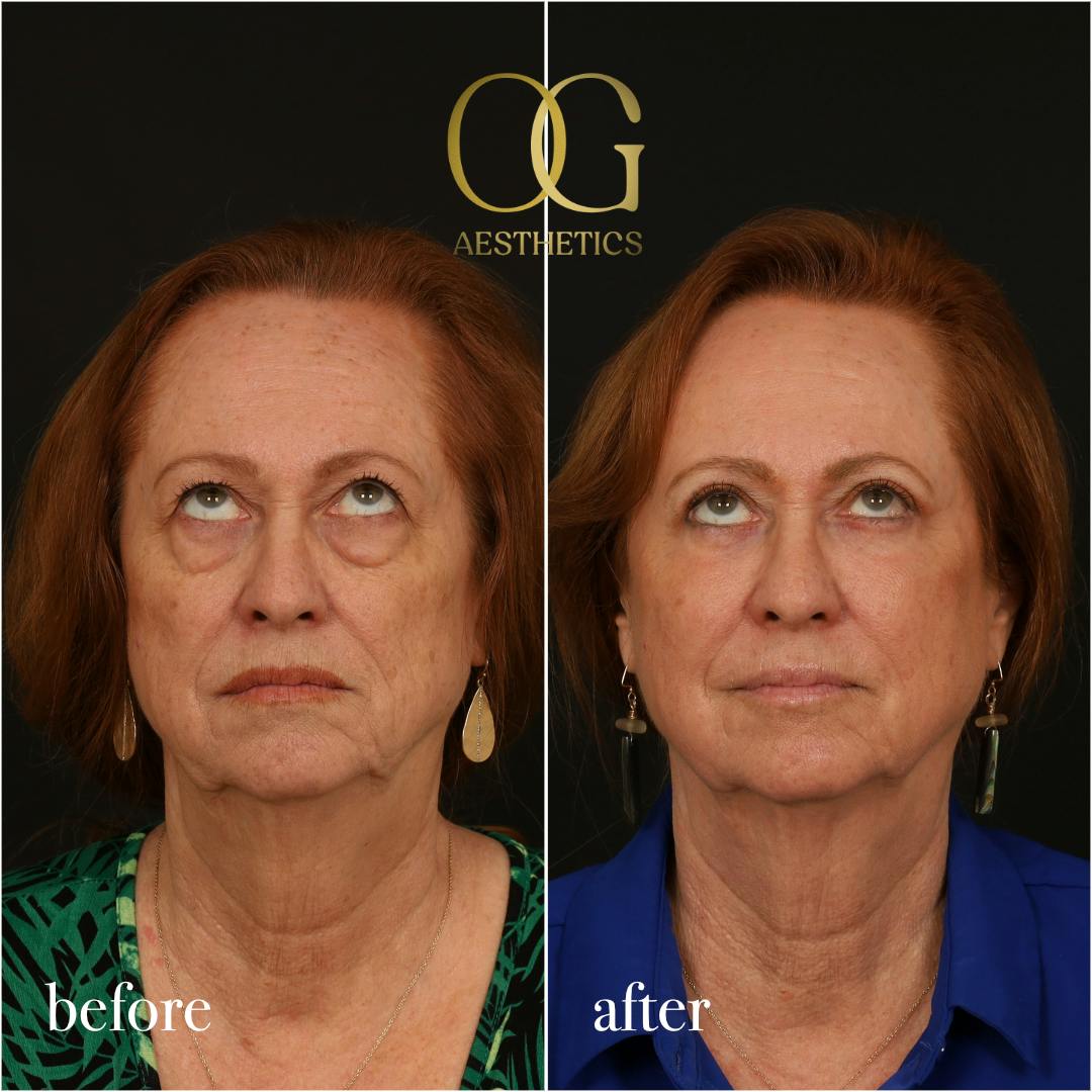 Blepharoplasty Before & After Gallery - Patient 298792 - Image 3
