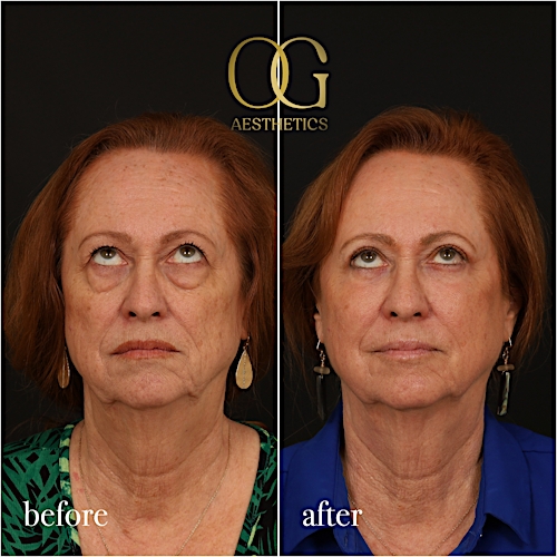 Blepharoplasty Before & After Gallery - Patient 298792 - Image 3