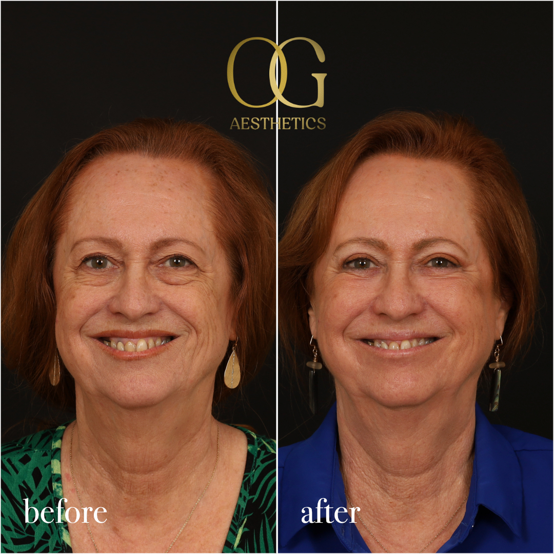 Blepharoplasty Before & After Gallery - Patient 298792 - Image 2