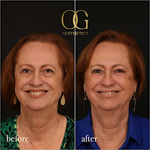 Blepharoplasty Before & After Gallery - Patient 298792 - Image 2