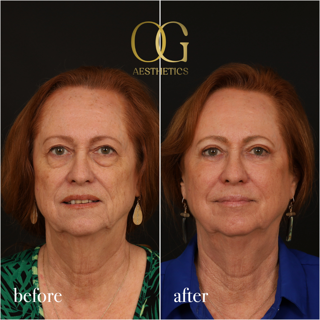 Blepharoplasty Before & After Gallery - Patient 298792 - Image 1
