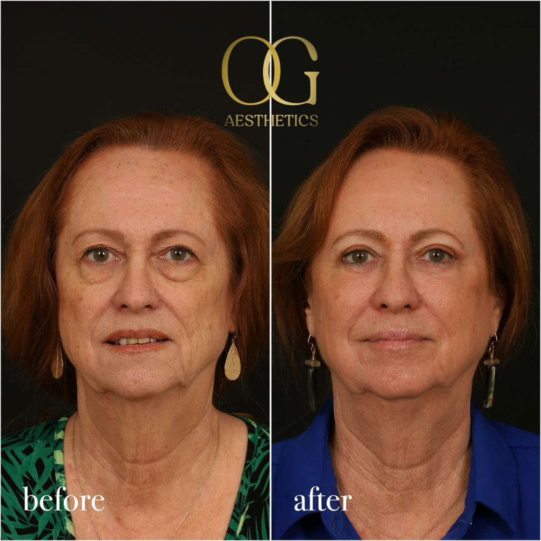 Blepharoplasty Before & After Gallery - Patient 298792 - Image 1