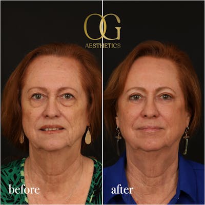 Blepharoplasty Before & After Gallery - Patient 298792 - Image 1