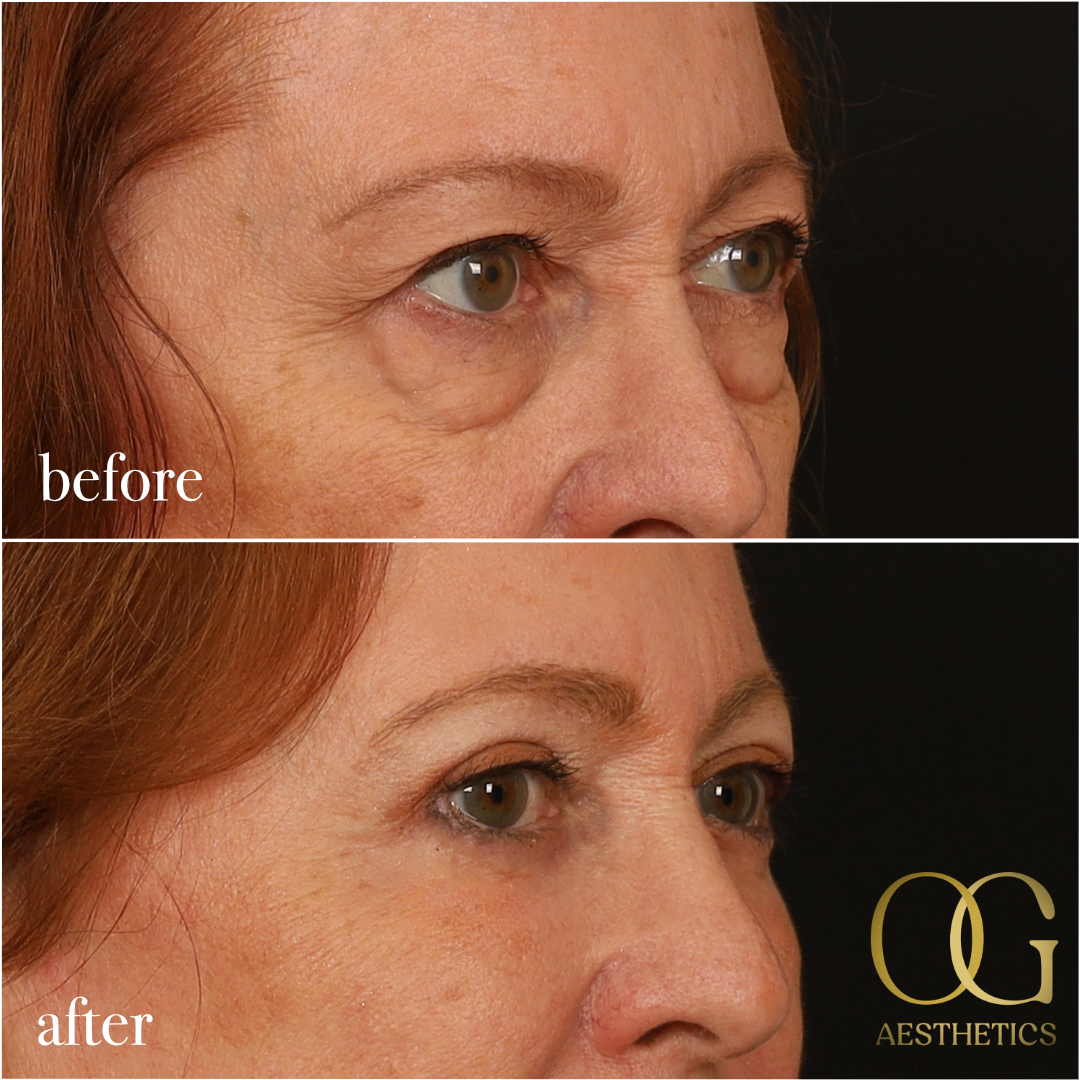 Blepharoplasty Before & After Gallery - Patient 298792 - Image 12