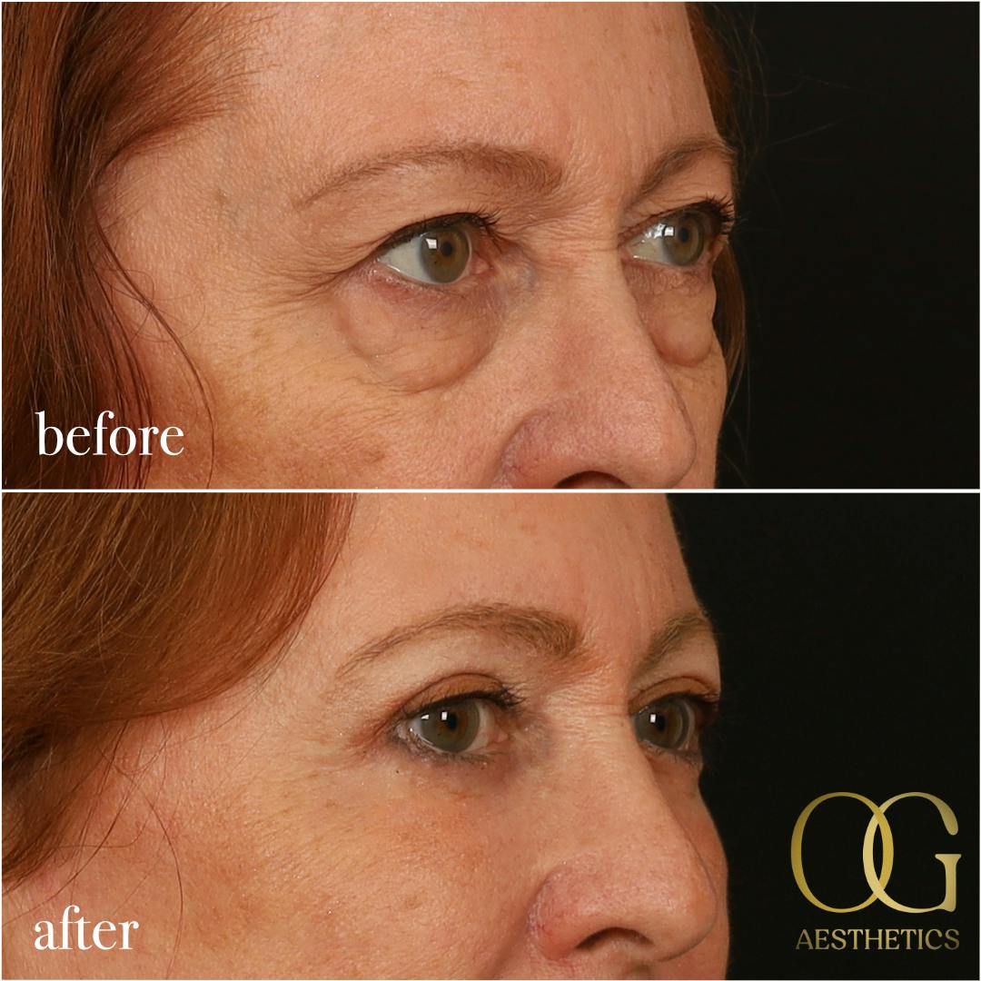Blepharoplasty Before & After Gallery - Patient 298792 - Image 12