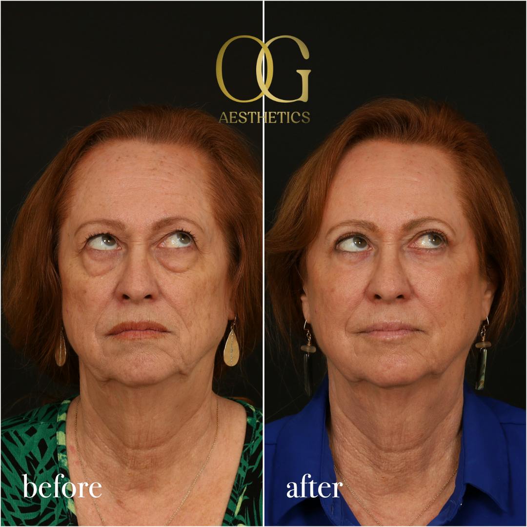Blepharoplasty Before & After Gallery - Patient 298792 - Image 4