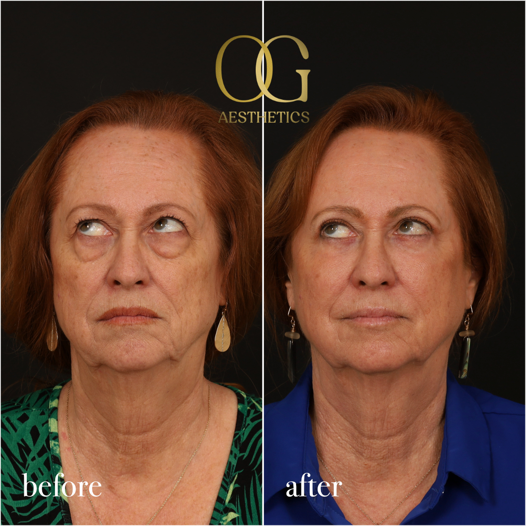 Blepharoplasty Before & After Gallery - Patient 298792 - Image 5