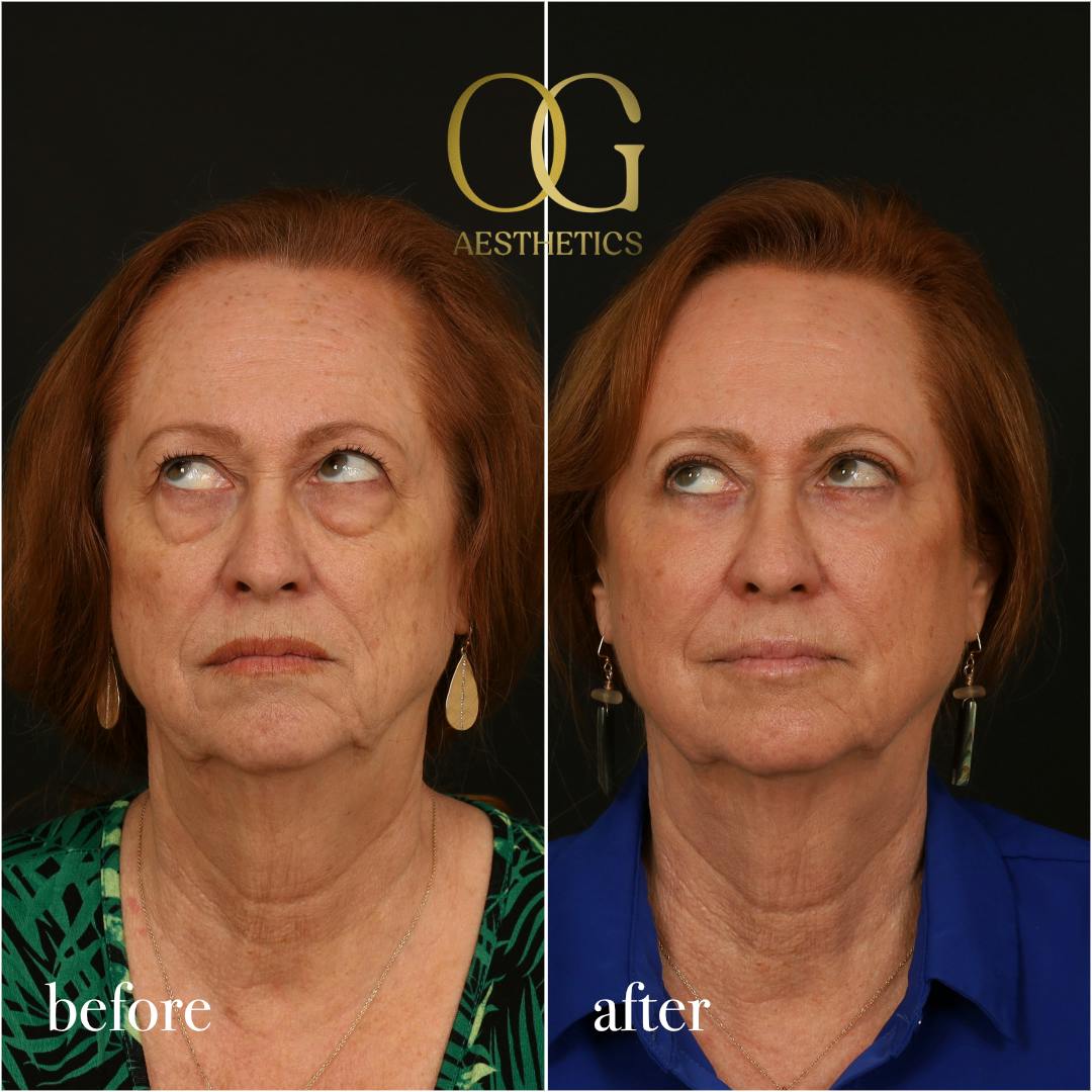 Blepharoplasty Before & After Gallery - Patient 298792 - Image 5