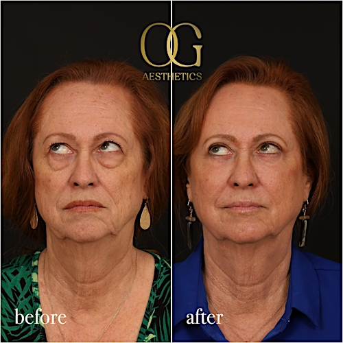Blepharoplasty Before & After Gallery - Patient 298792 - Image 5