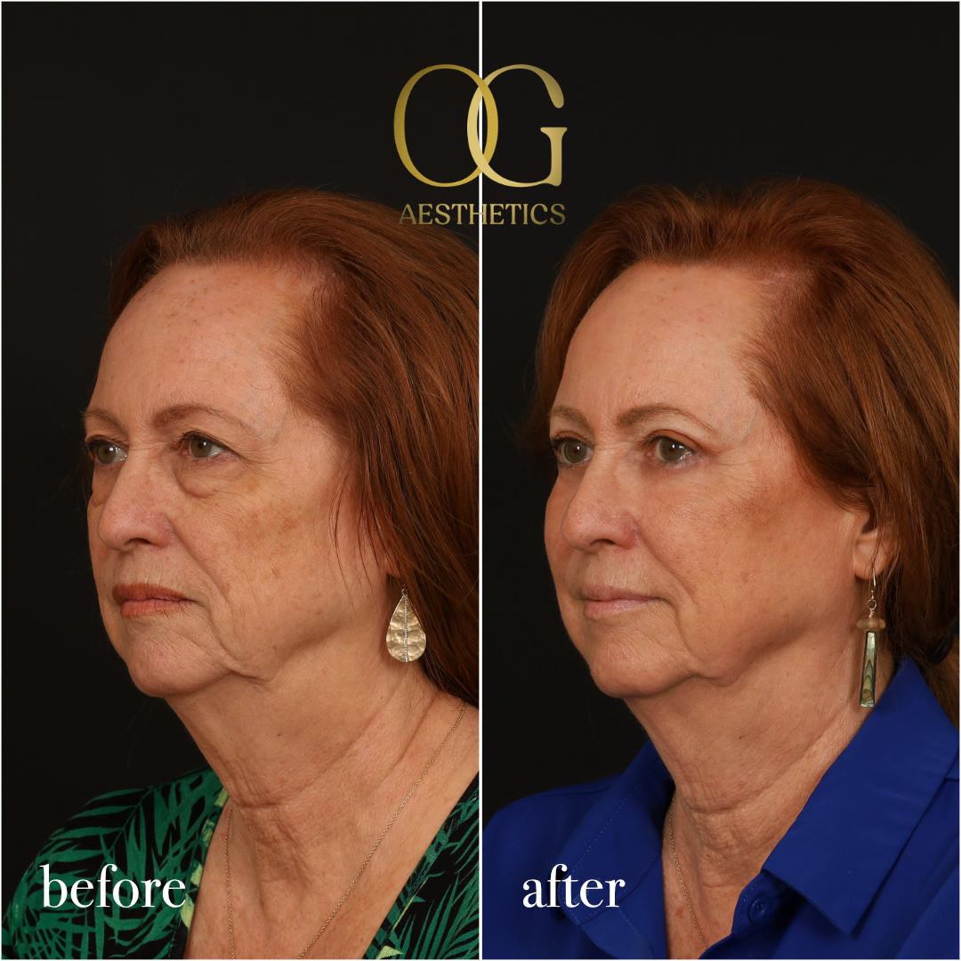 Blepharoplasty Before & After Gallery - Patient 298792 - Image 8