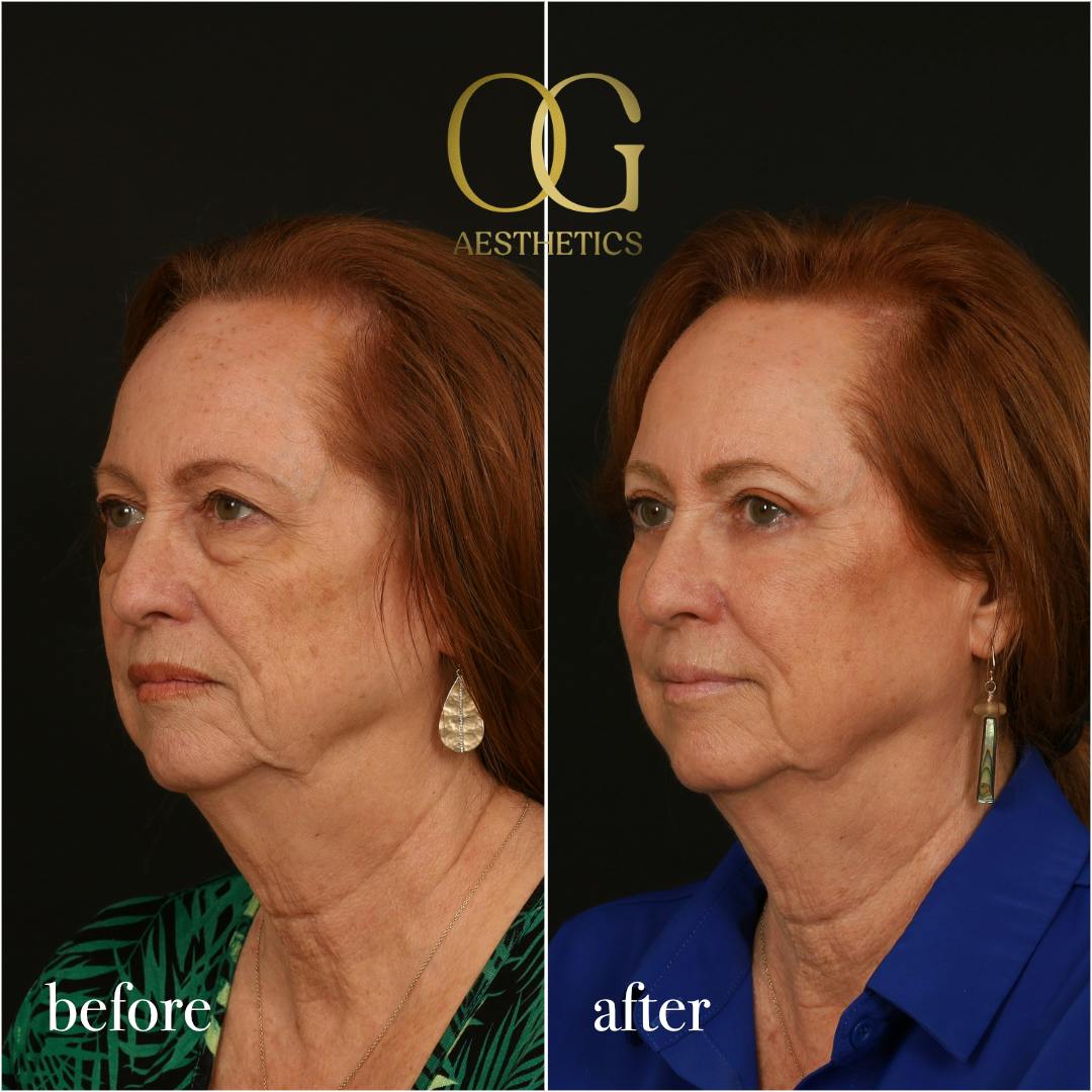 Blepharoplasty Before & After Gallery - Patient 298792 - Image 8
