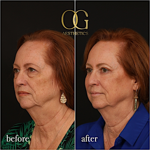 Blepharoplasty Before & After Gallery - Patient 298792 - Image 8