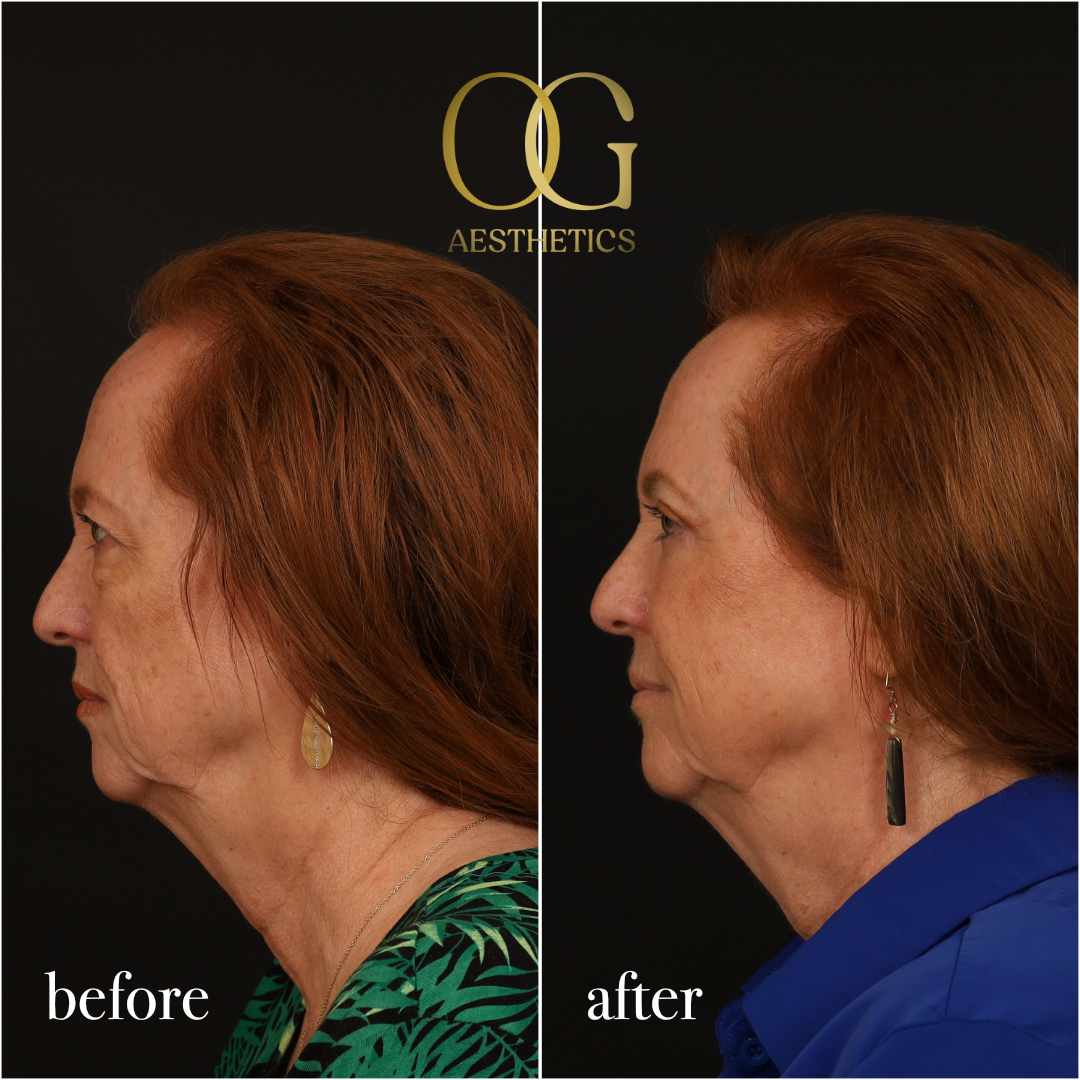 Blepharoplasty Before & After Gallery - Patient 298792 - Image 9