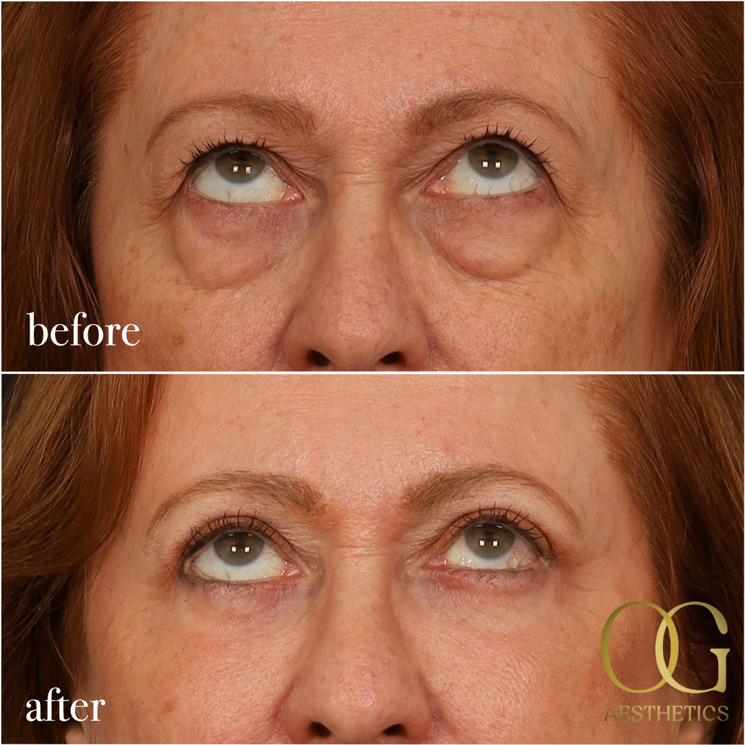 Blepharoplasty Before & After Gallery - Patient 298792 - Image 11