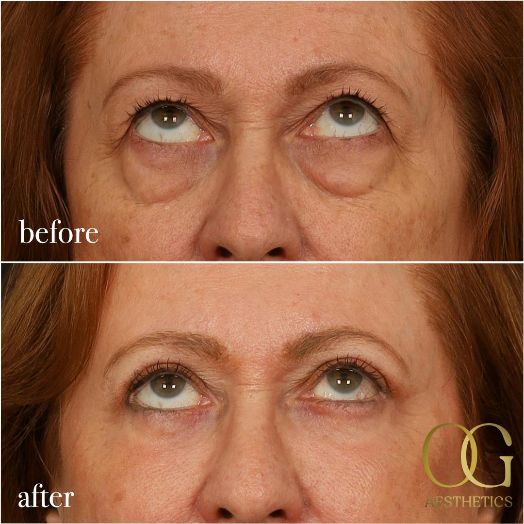 Blepharoplasty Before & After Gallery - Patient 298792 - Image 11