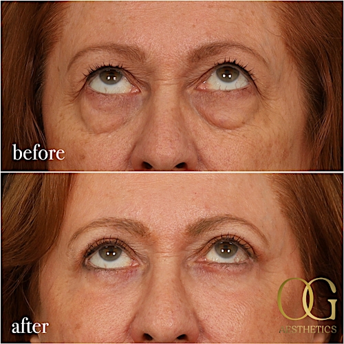 Blepharoplasty Before & After Gallery - Patient 298792 - Image 11