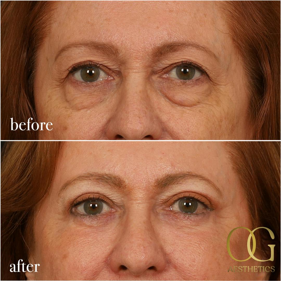 Blepharoplasty Before & After Gallery - Patient 298792 - Image 10