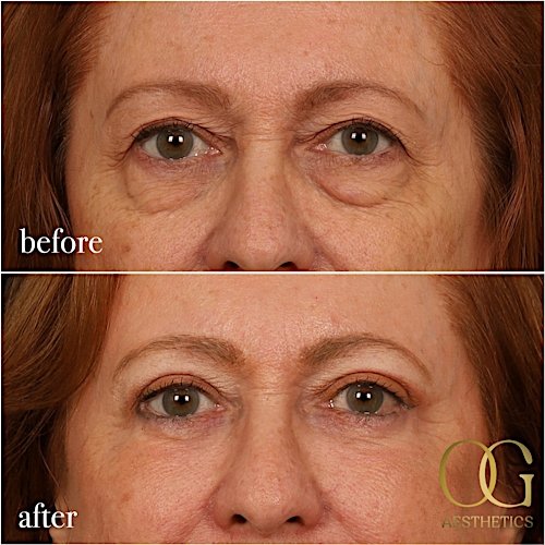 Blepharoplasty Before & After Gallery - Patient 298792 - Image 10
