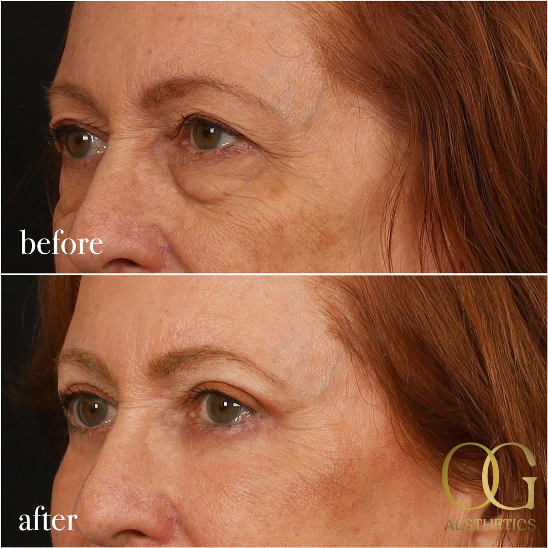 Blepharoplasty Before & After Gallery - Patient 298792 - Image 13