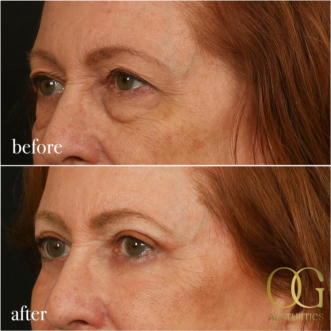 Blepharoplasty Before & After Gallery - Patient 298792 - Image 13