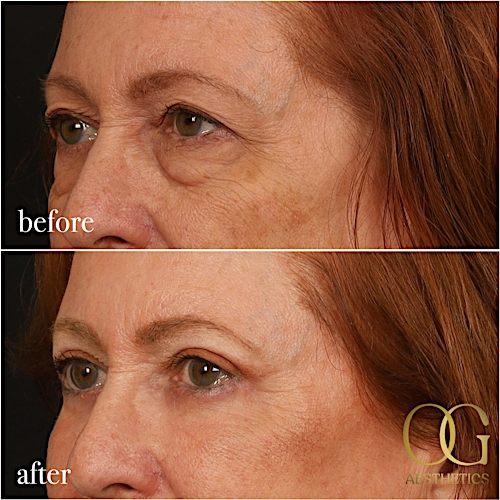 Blepharoplasty Before & After Gallery - Patient 298792 - Image 13