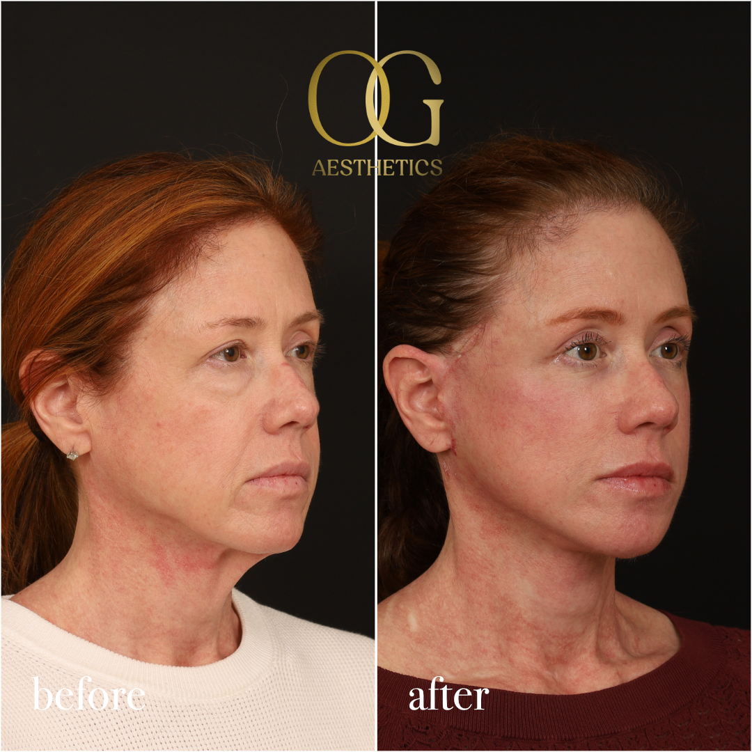 Fat Transfer Before & After Gallery - Patient 310523 - Image 3