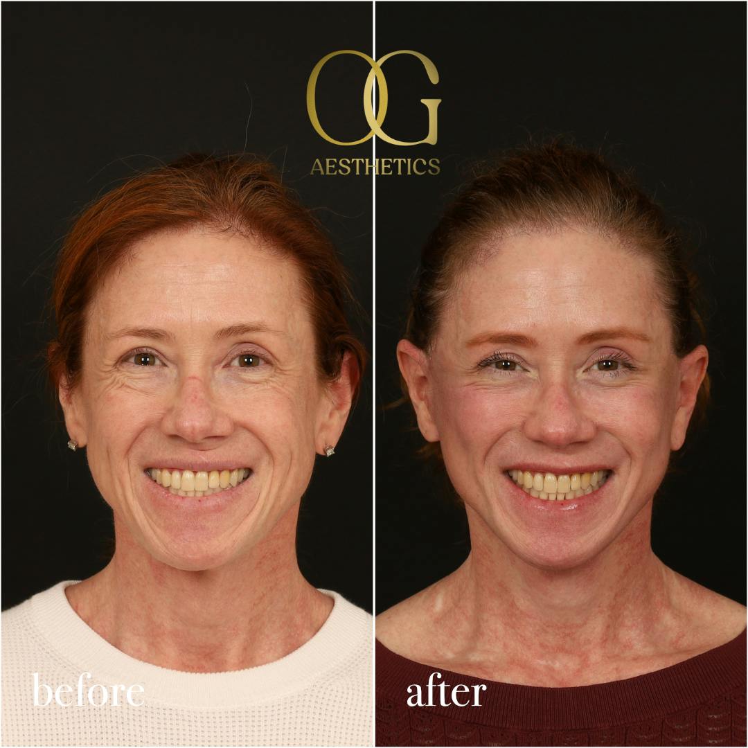 Fat Transfer Before & After Gallery - Patient 310523 - Image 2