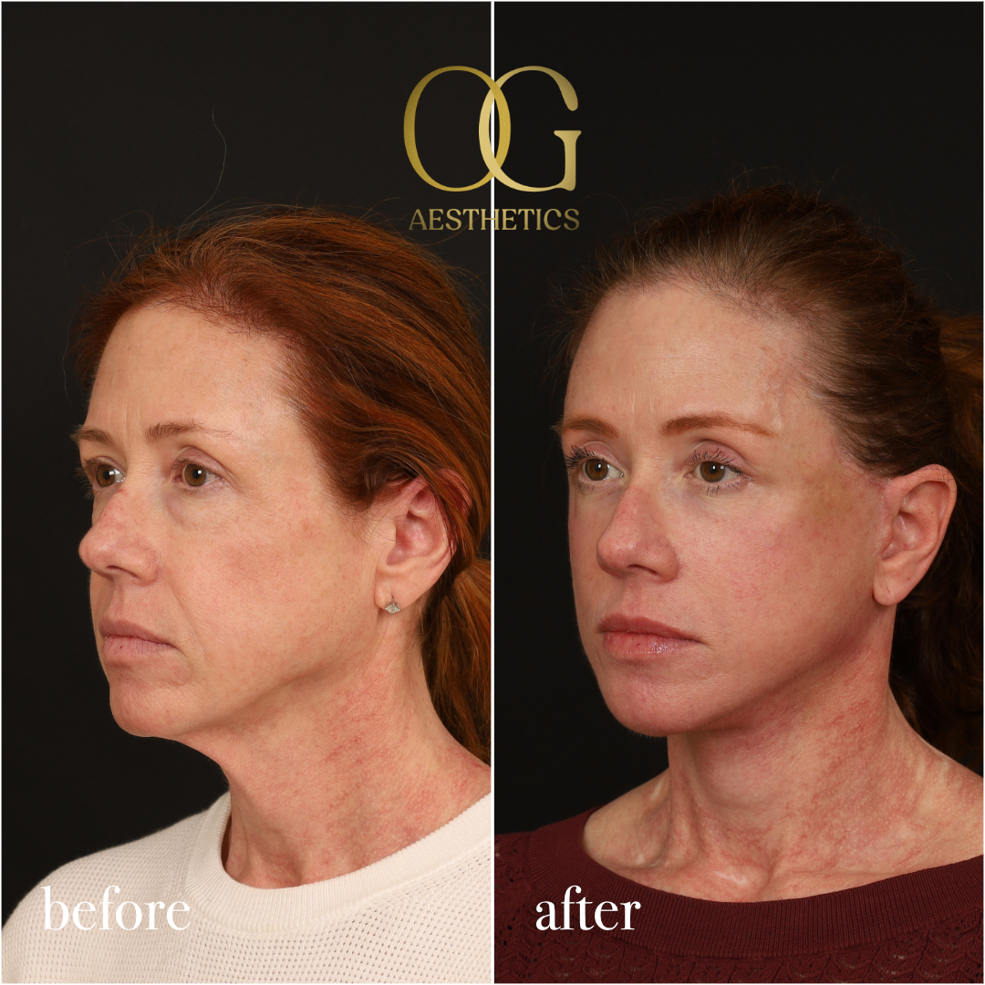 Fat Transfer Before & After Gallery - Patient 310523 - Image 5