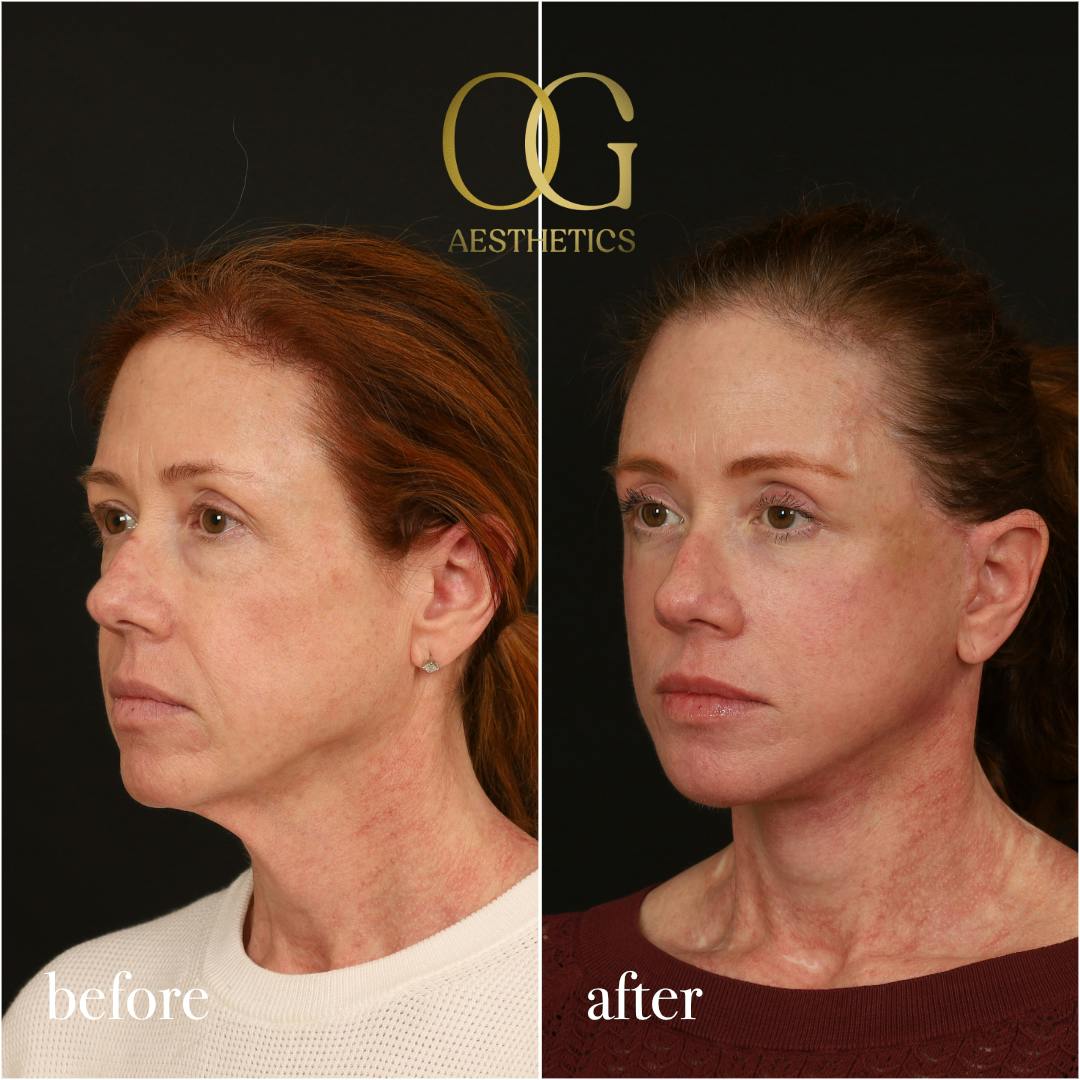 Fat Transfer Before & After Gallery - Patient 310523 - Image 5