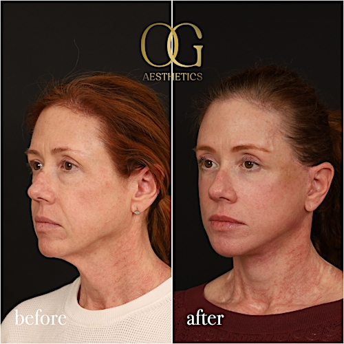 Fat Transfer Before & After Gallery - Patient 310523 - Image 5