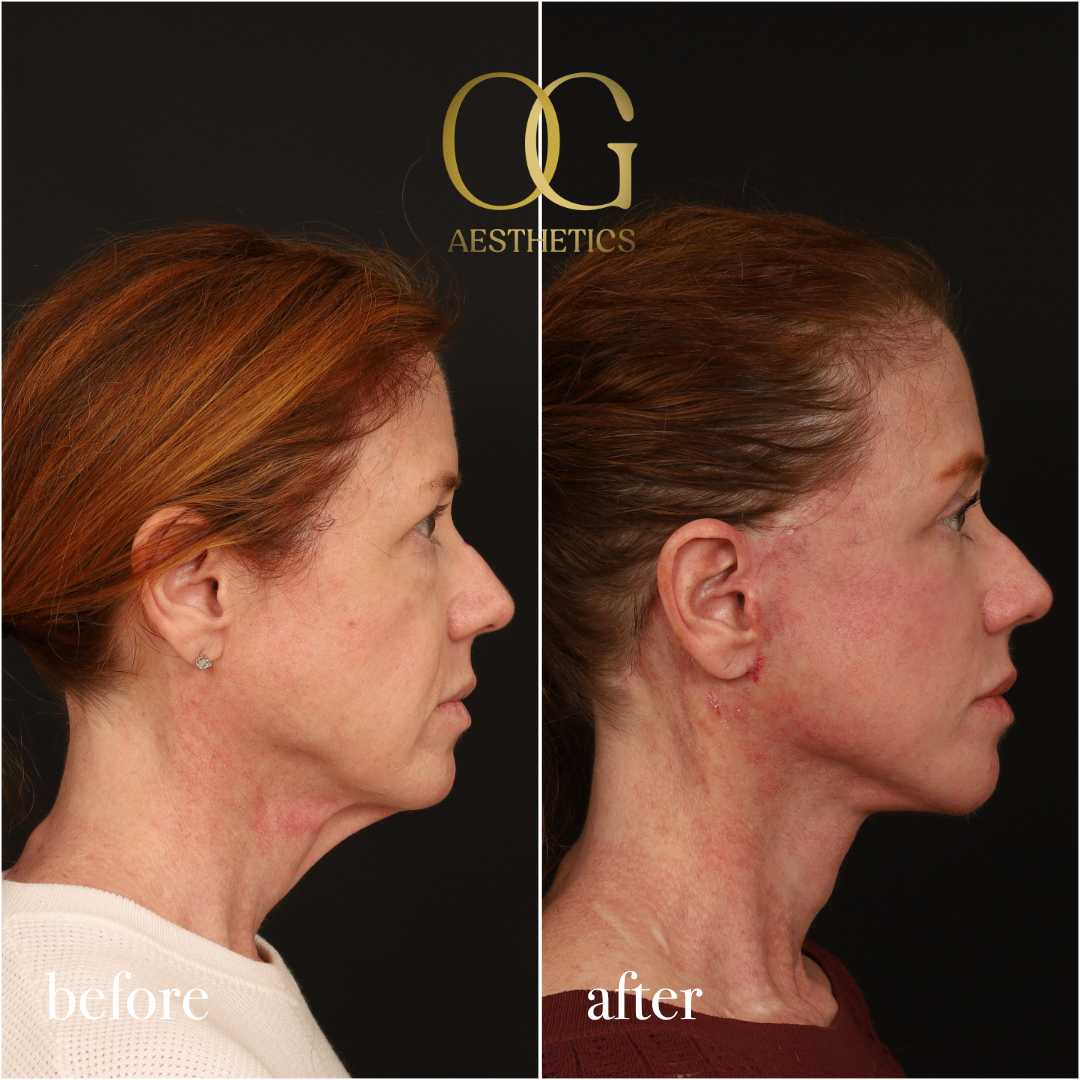 Fat Transfer Before & After Gallery - Patient 310523 - Image 4