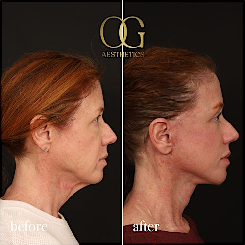 Fat Transfer Before & After Gallery - Patient 310523 - Image 4