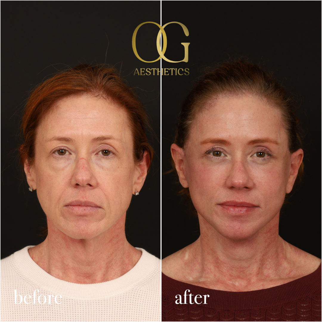 Fat Transfer Before & After Gallery - Patient 310523 - Image 1
