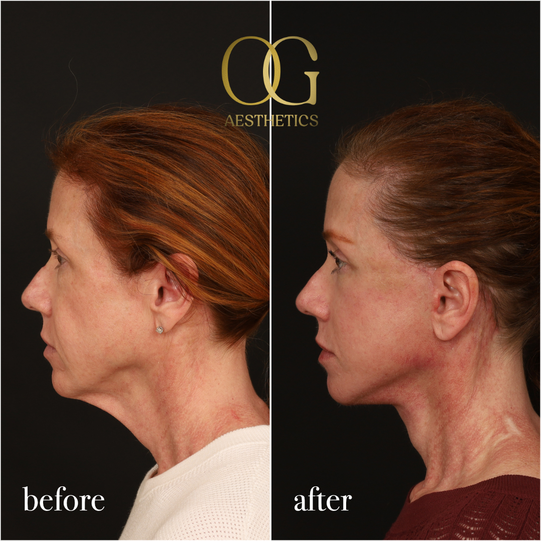 Fat Transfer Before & After Gallery - Patient 310523 - Image 6