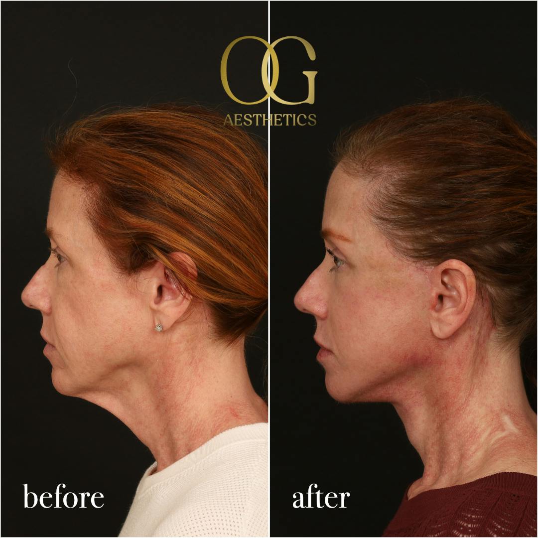 Fat Transfer Before & After Gallery - Patient 310523 - Image 6