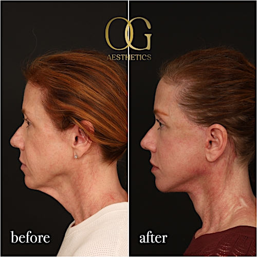 Fat Transfer Before & After Gallery - Patient 310523 - Image 6