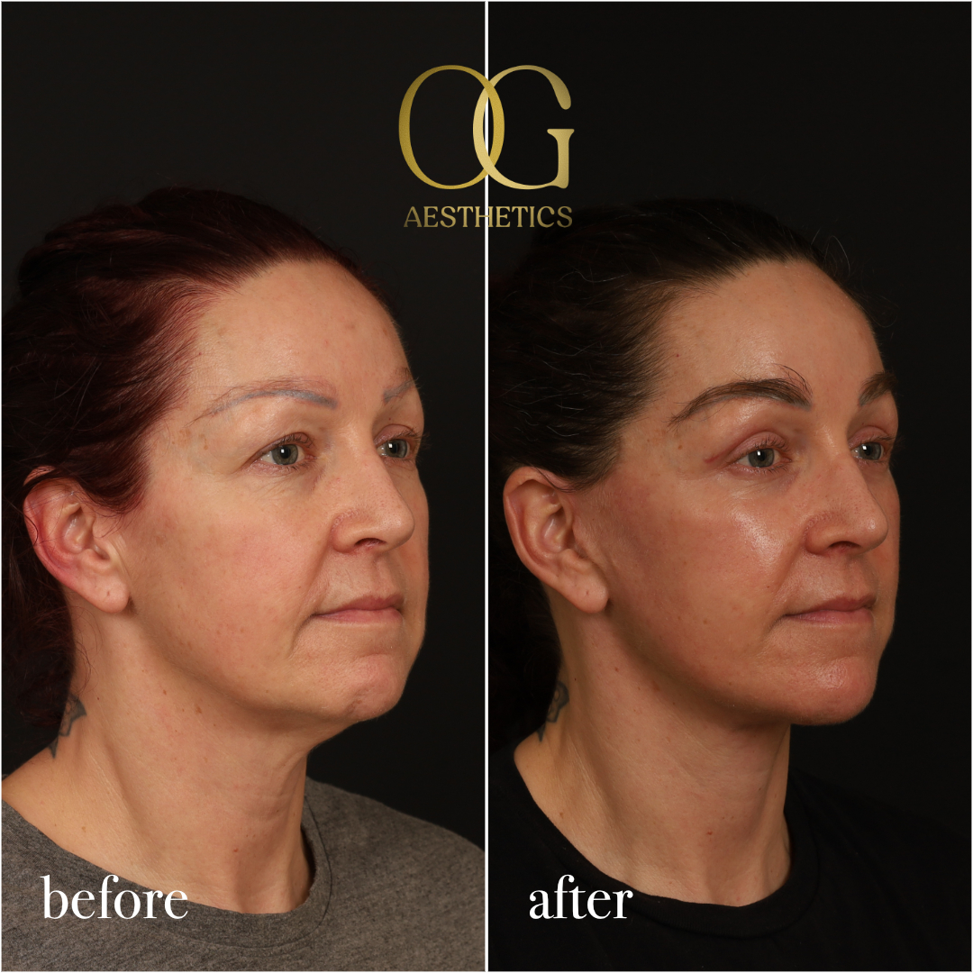 Fat Transfer Before & After Gallery - Patient 229052 - Image 5