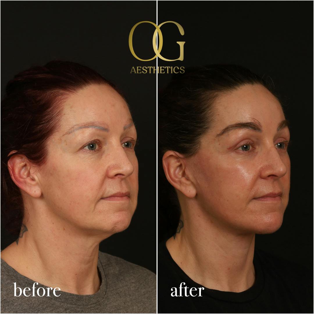 Fat Transfer Before & After Gallery - Patient 229052 - Image 5