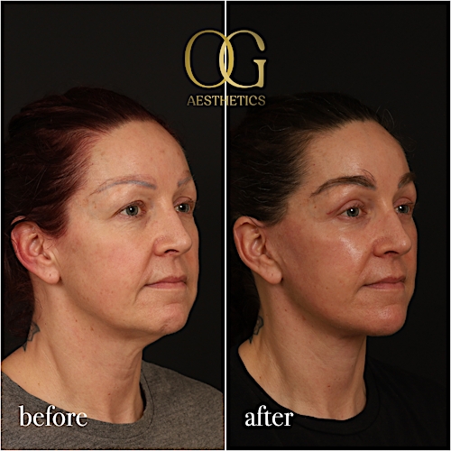 Fat Transfer Before & After Gallery - Patient 229052 - Image 5