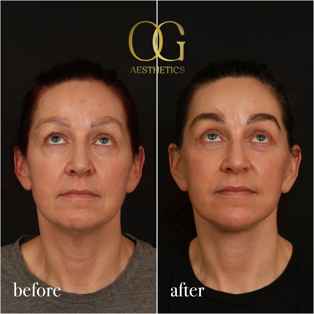 Fat Transfer Before & After Gallery - Patient 229052 - Image 3