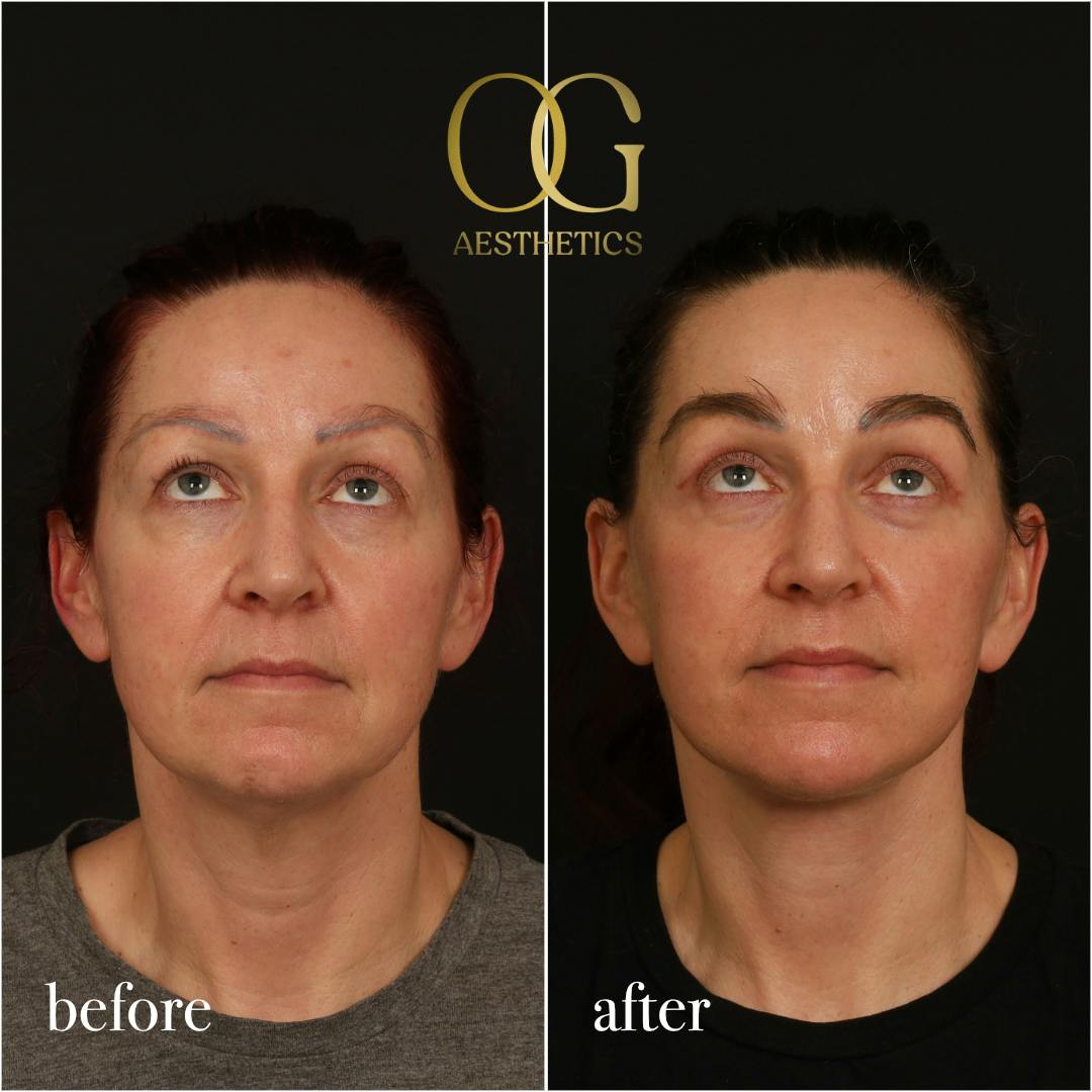 Fat Transfer Before & After Gallery - Patient 229052 - Image 3