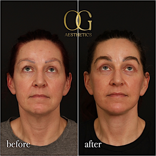 Fat Transfer Before & After Gallery - Patient 229052 - Image 3