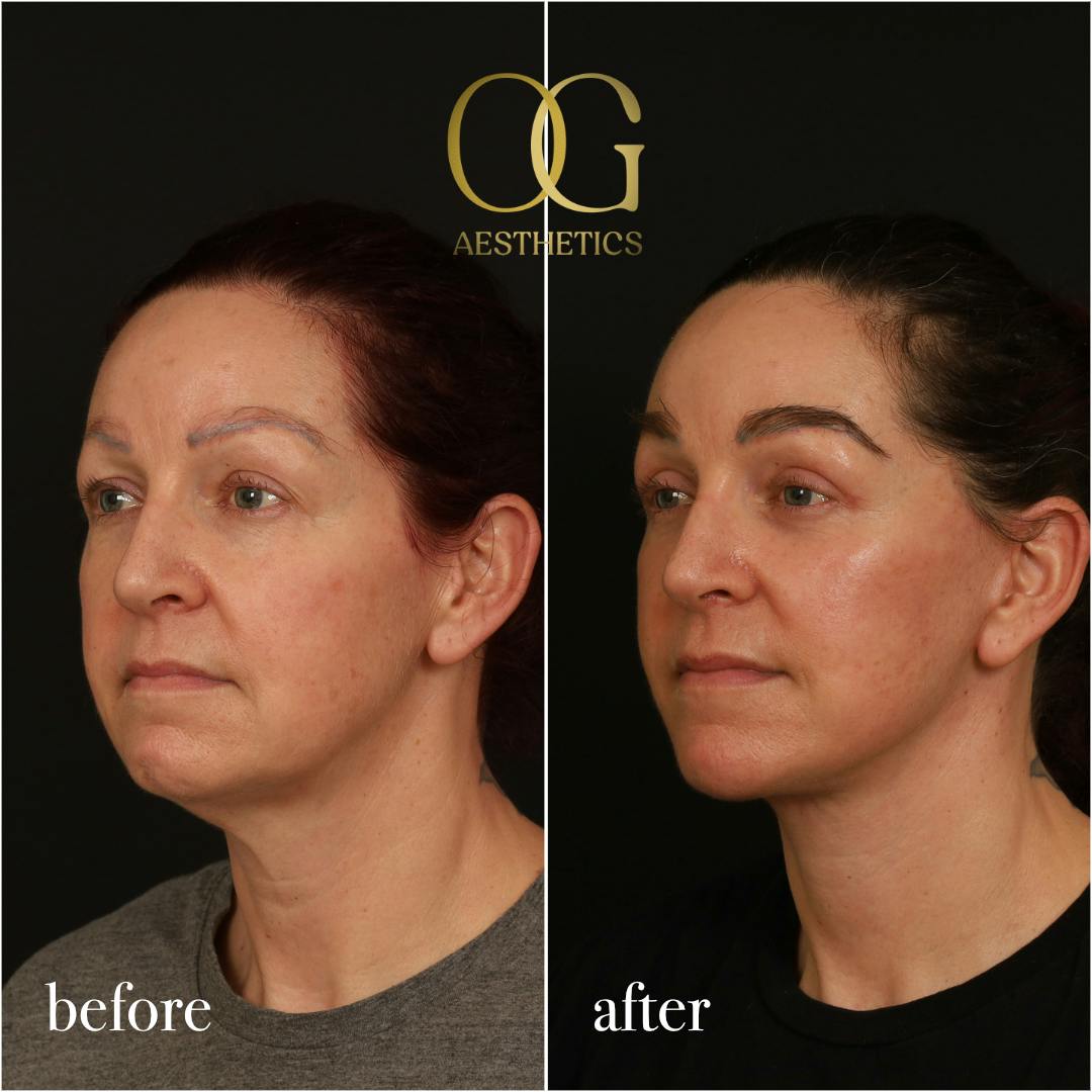Fat Transfer Before & After Gallery - Patient 229052 - Image 7