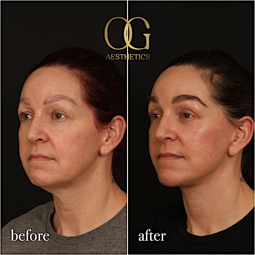Fat Transfer Before & After Gallery - Patient 229052 - Image 7