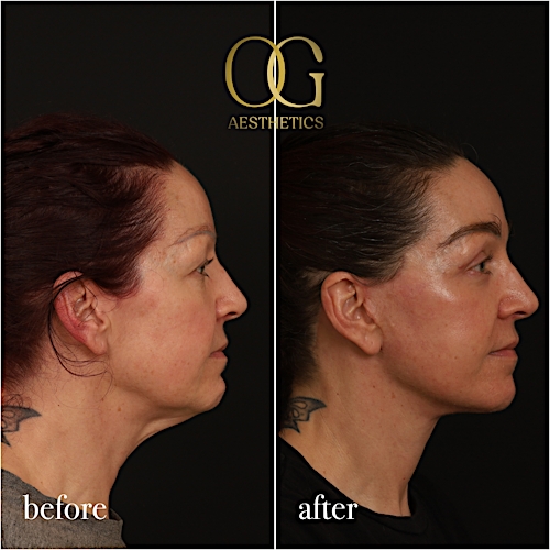 Fat Transfer Before & After Gallery - Patient 229052 - Image 6