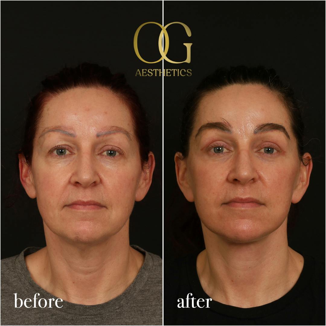 Fat Transfer Before & After Gallery - Patient 229052 - Image 1
