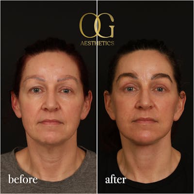 Blepharoplasty Before & After Gallery - Patient 167010 - Image 1