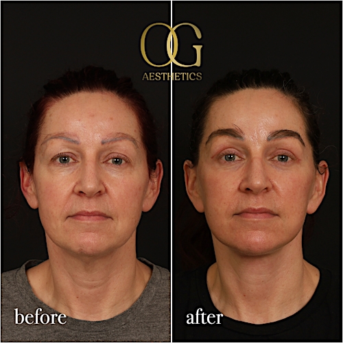 Fat Transfer Before & After Gallery - Patient 229052 - Image 1
