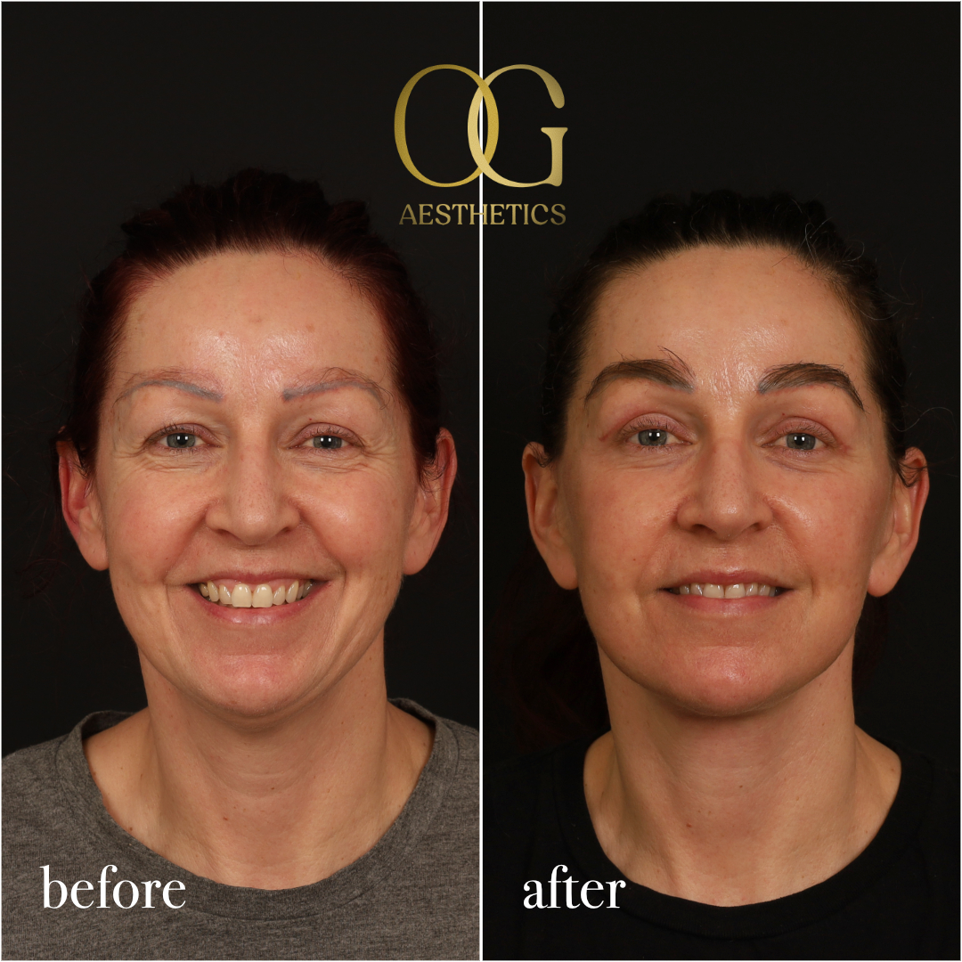 Fat Transfer Before & After Gallery - Patient 229052 - Image 2