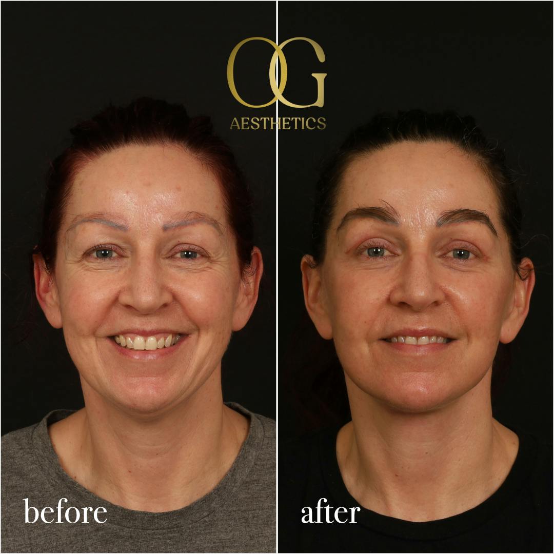 Fat Transfer Before & After Gallery - Patient 229052 - Image 2